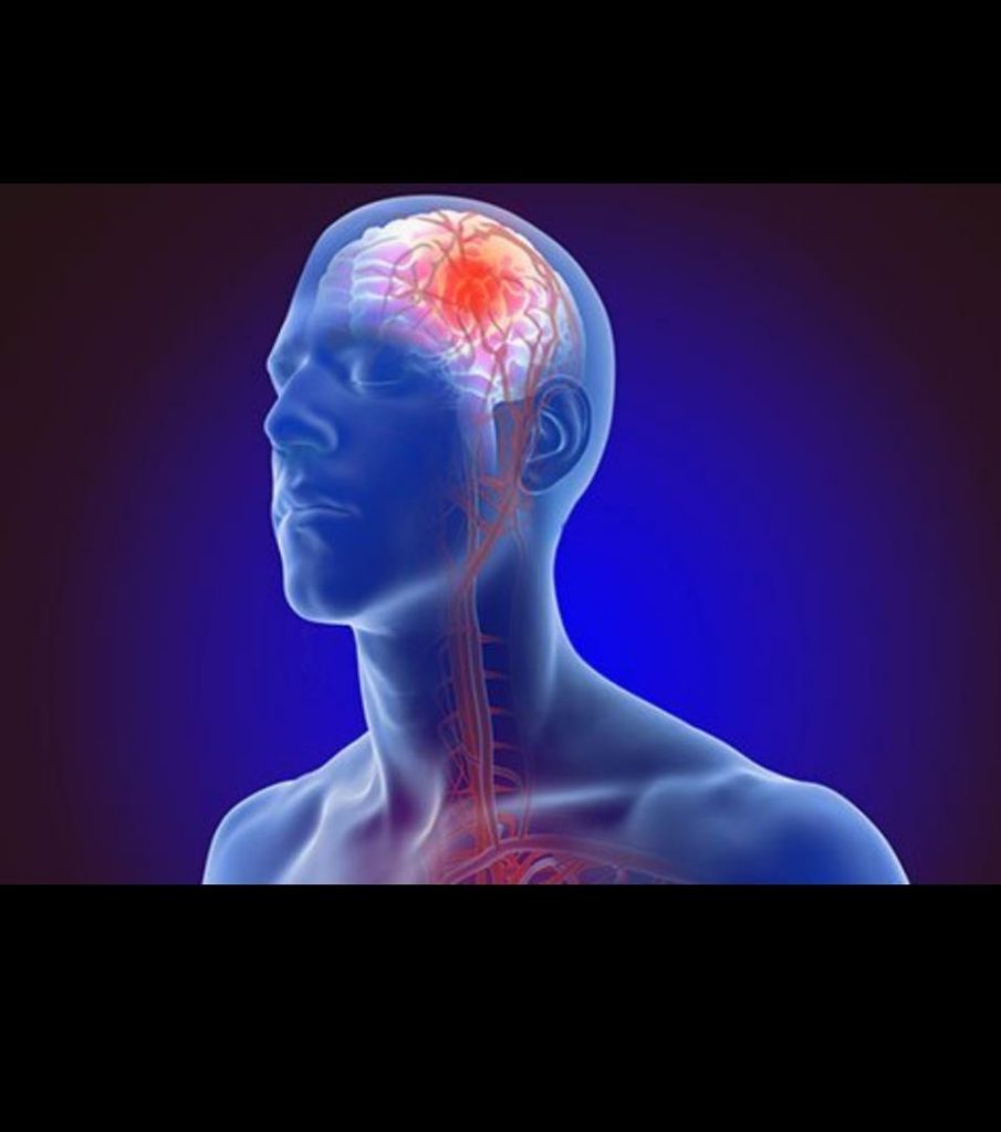 cerebrovascular-accident-stroke-how-can-it-be-avoided-stocksng